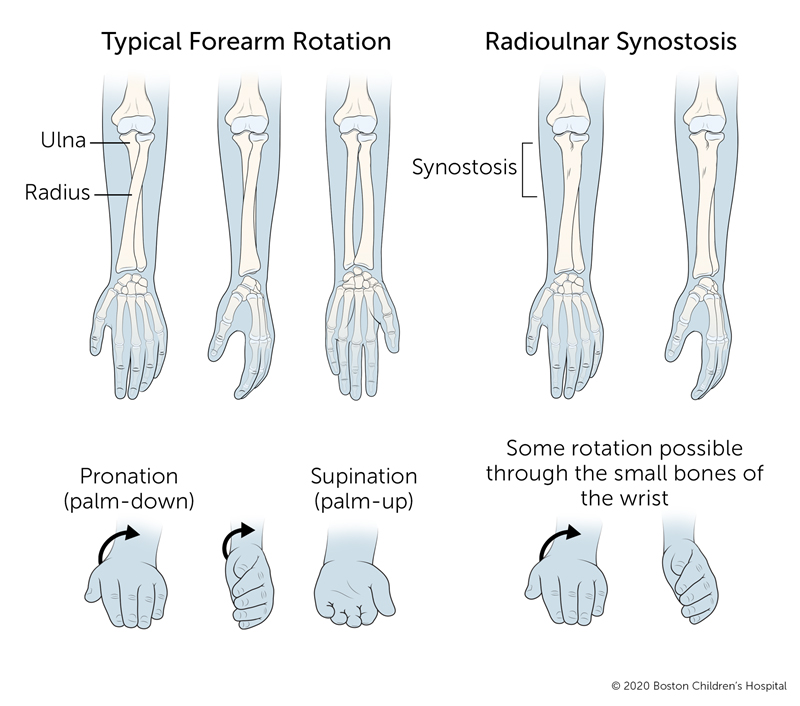 Diagram comparing a typical forearm, where the radius rotates around the ulna for palm-down and palm-up positions, with radioulnar synostosis, where fused forearm bones limit rotation and some movement occurs at the wrist.